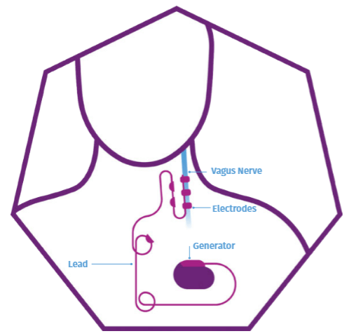 vns-surgery-placement-(2)
